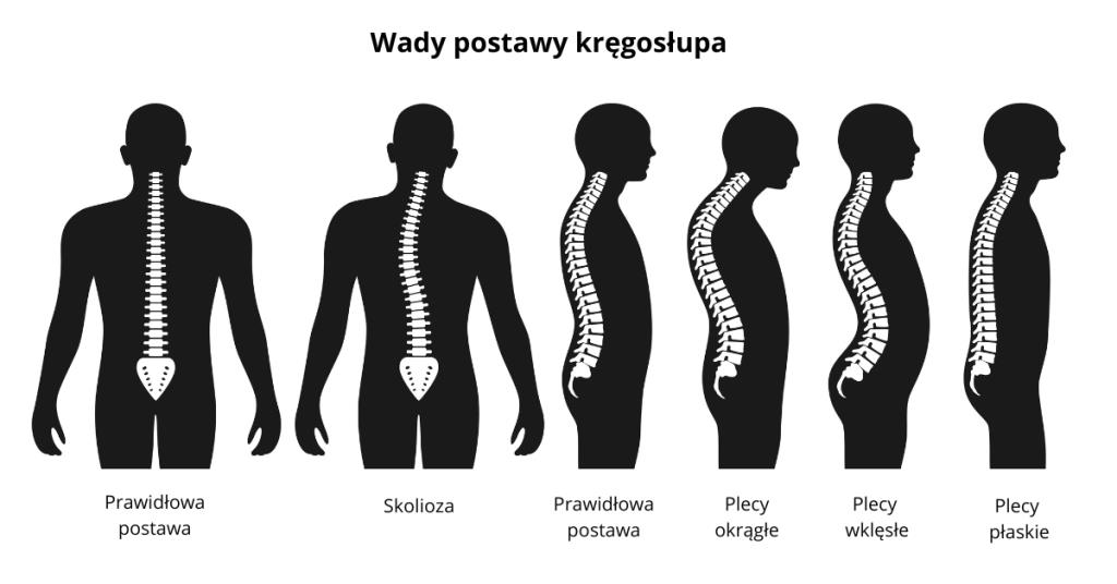 Wady kręgosłupa
